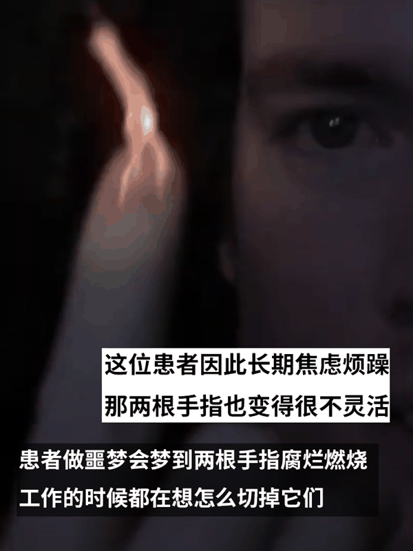 健康的大腿被直接锯掉！只因患上了身体完整认同障碍