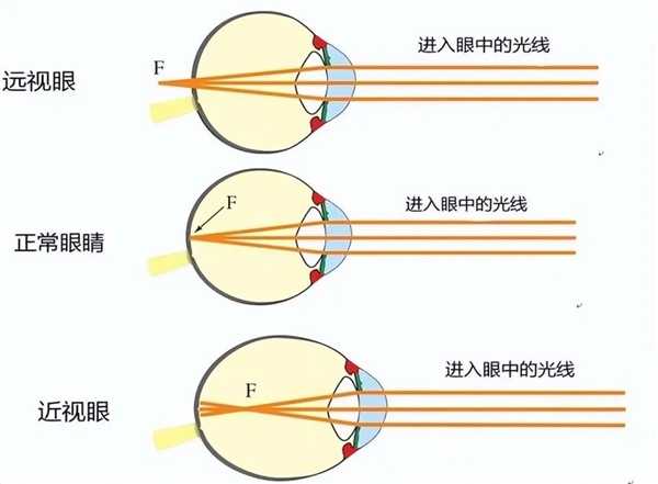 近视的人老之后：是视力逐渐变好 还是同时老花眼